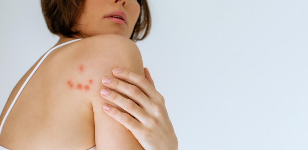 muscatura plosnite pe femeie tanara